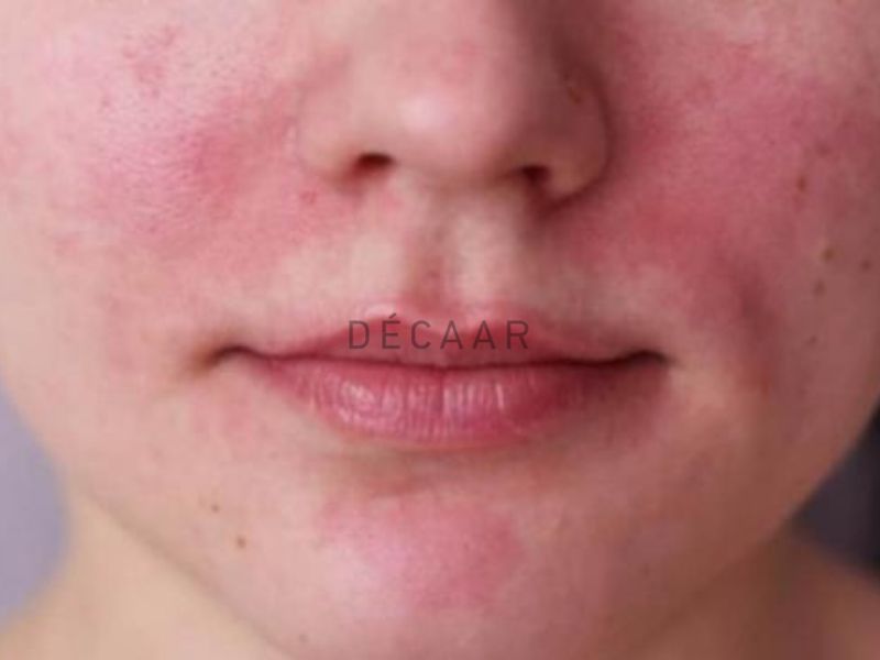 Giai đoạn tiền trứng cá đỏ
